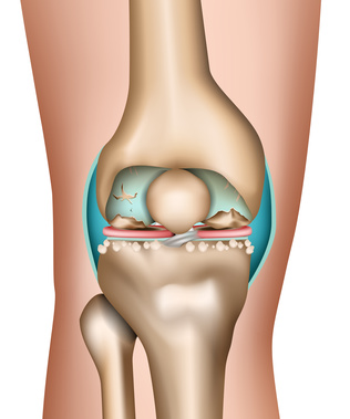 Cartilage Injury & surgery
